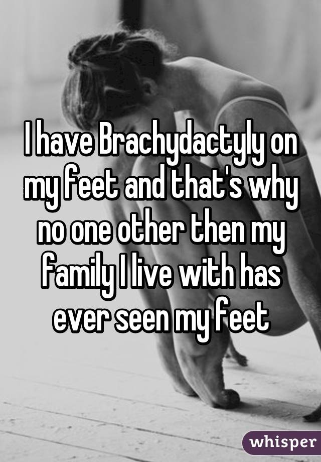 I have Brachydactyly on my feet and that's why no one other then my family I live with has ever seen my feet