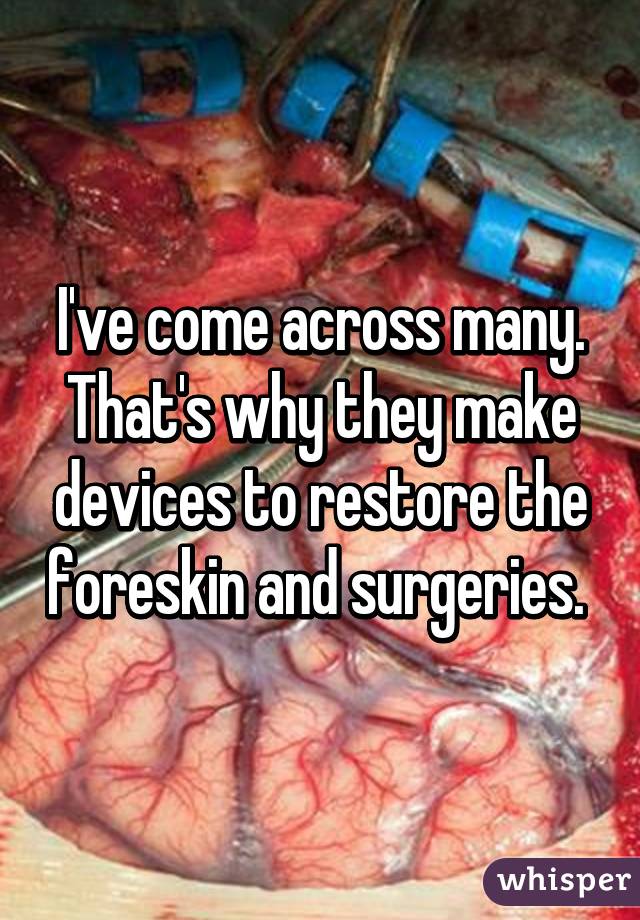 I've come across many. That's why they make devices to restore the foreskin and surgeries. 