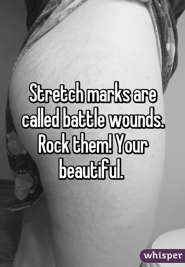 Stretch marks are called battle wounds. Rock them! Your beautiful. 