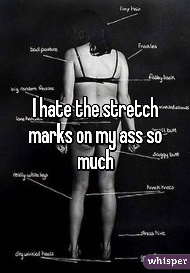 I hate the stretch marks on my ass so much