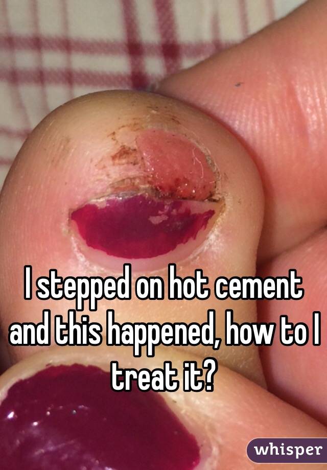 I stepped on hot cement and this happened, how to I treat it?