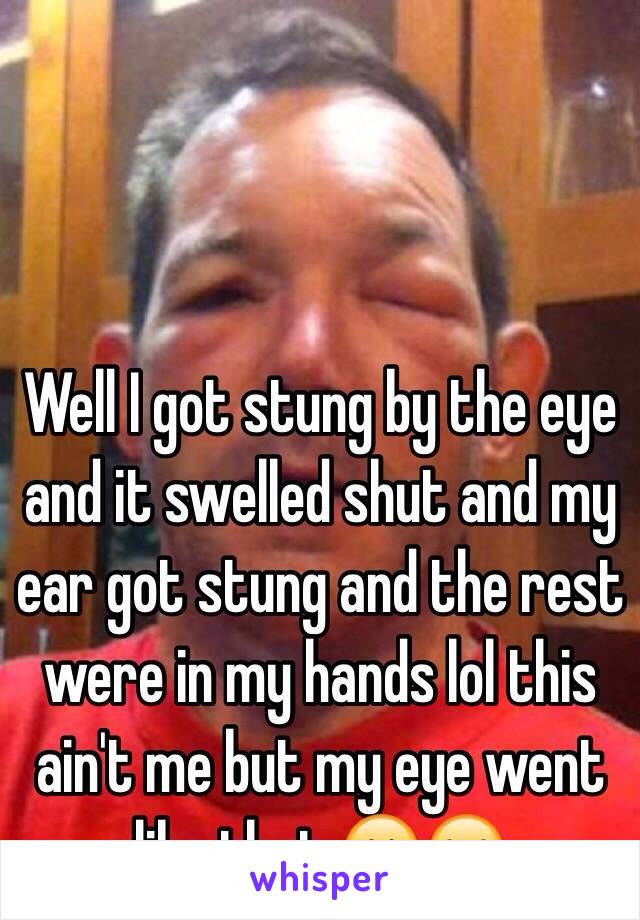 Well I got stung by the eye and it swelled shut and my ear got stung and the rest were in my hands lol this ain't me but my eye went like that 😁😂
