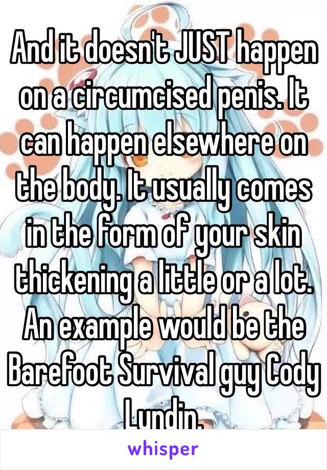 And it doesn't JUST happen on a circumcised penis. It can happen elsewhere on the body. It usually comes in the form of your skin thickening a little or a lot. An example would be the Barefoot Survival guy Cody Lundin. 