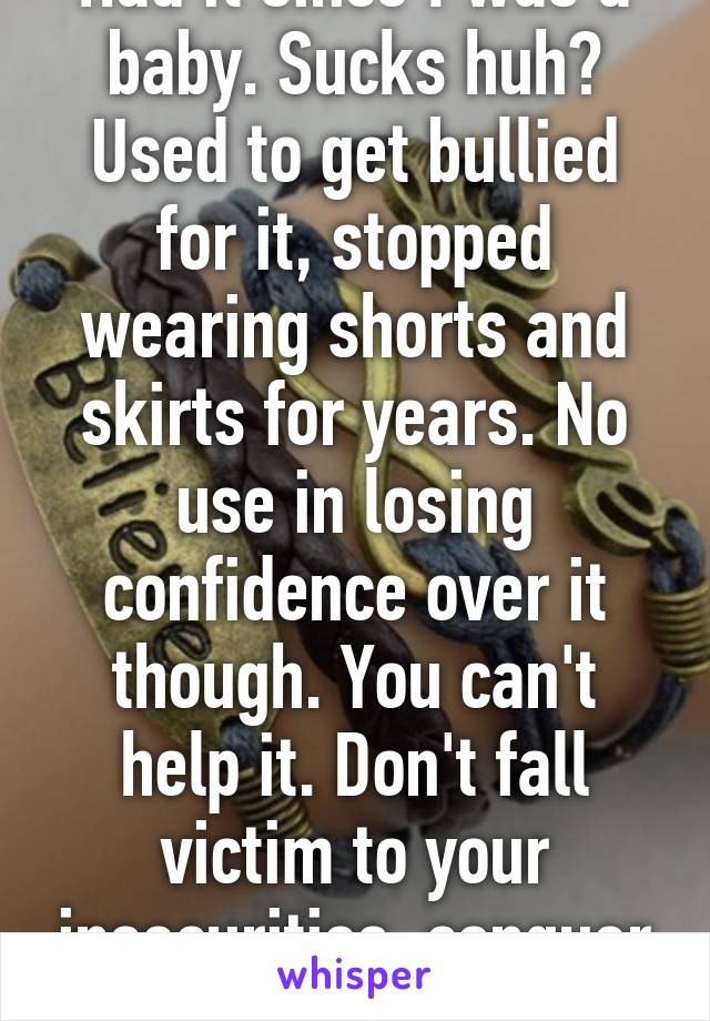 Had it since I was a baby. Sucks huh? Used to get bullied for it, stopped wearing shorts and skirts for years. No use in losing confidence over it though. You can't help it. Don't fall victim to your insecurities, conquer them.