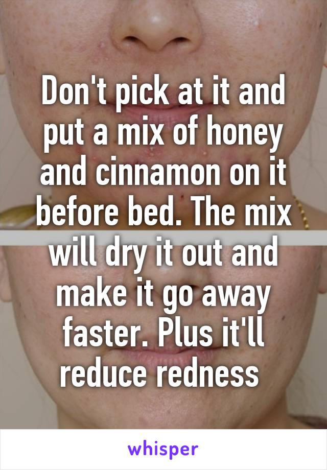 Don't pick at it and put a mix of honey and cinnamon on it before bed. The mix will dry it out and make it go away faster. Plus it'll reduce redness 