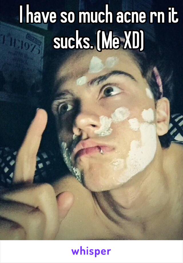 I have so much acne rn it sucks. (Me XD)