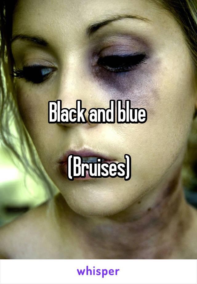 Black and blue 

(Bruises)