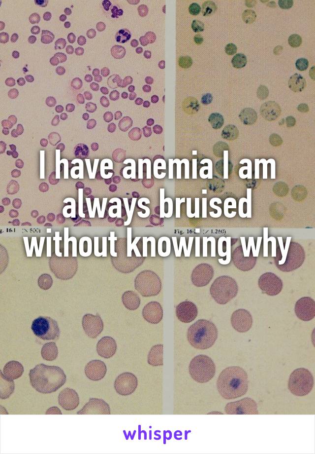 I have anemia I am always bruised without knowing why 