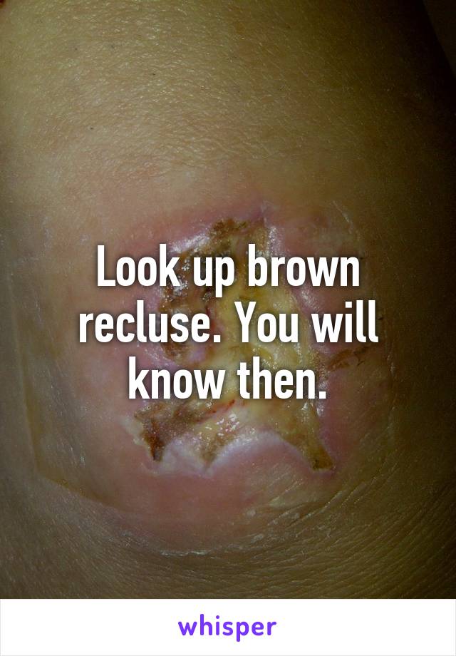 Look up brown recluse. You will know then.