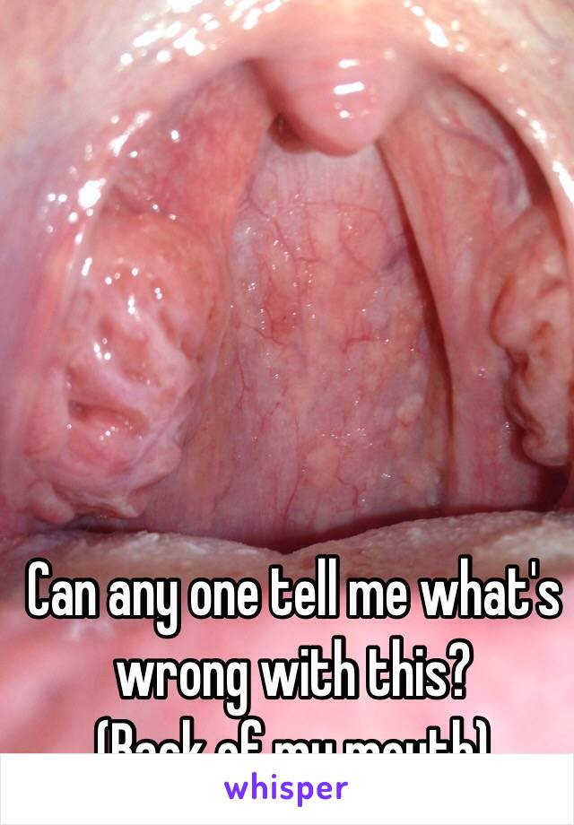 Can any one tell me what's wrong with this?
(Back of my mouth)