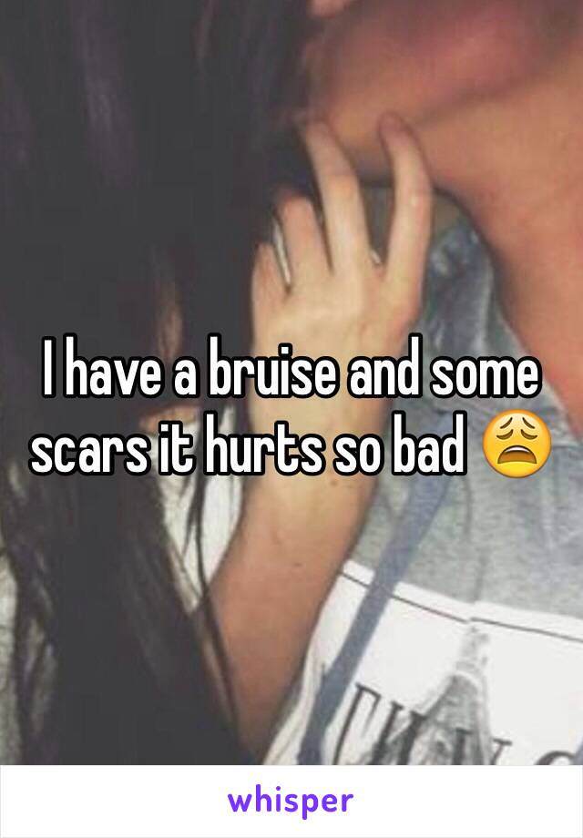 I have a bruise and some scars it hurts so bad 😩