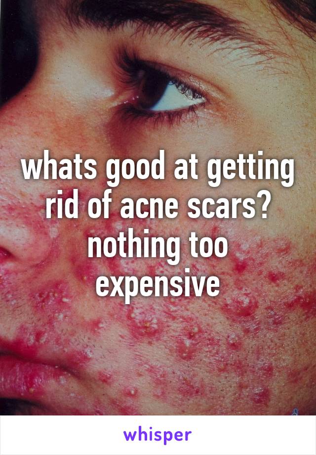 whats good at getting rid of acne scars?
nothing too expensive