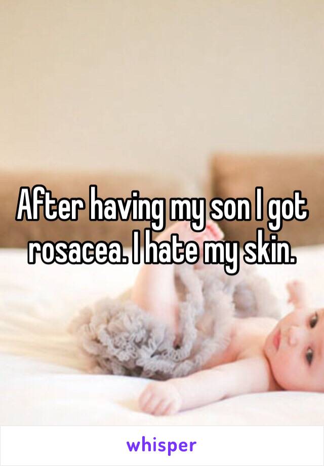 After having my son I got rosacea. I hate my skin.