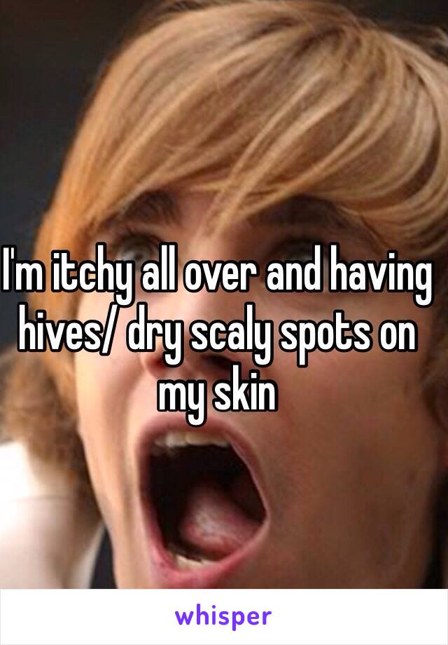 I'm itchy all over and having hives/ dry scaly spots on my skin