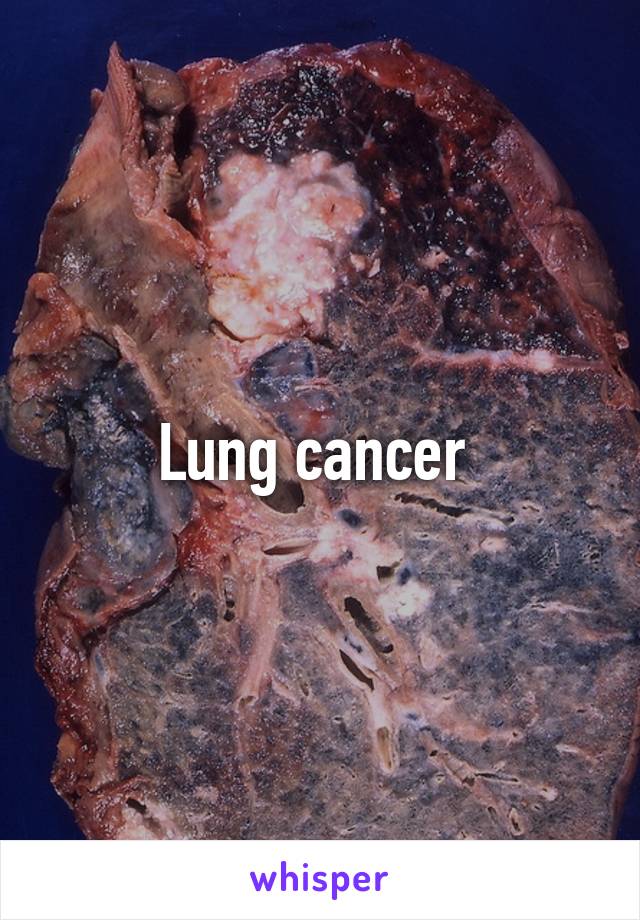 Lung cancer 