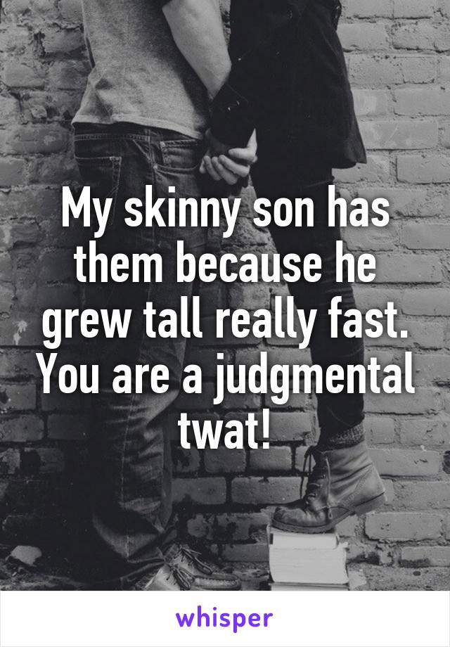 My skinny son has them because he grew tall really fast. You are a judgmental twat!