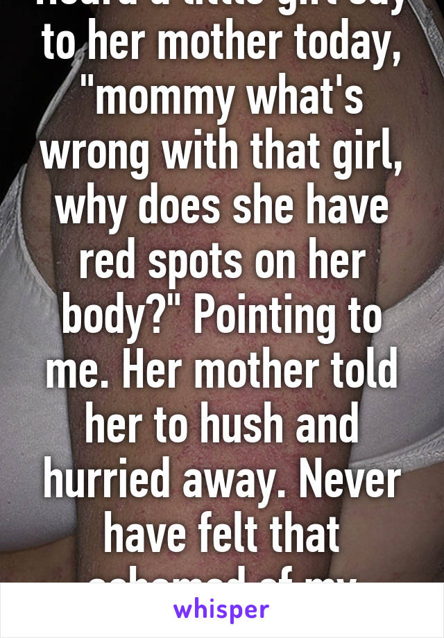 Heard a little girl say to her mother today, "mommy what's wrong with that girl, why does she have red spots on her body?" Pointing to me. Her mother told her to hush and hurried away. Never have felt that ashamed of my skin....