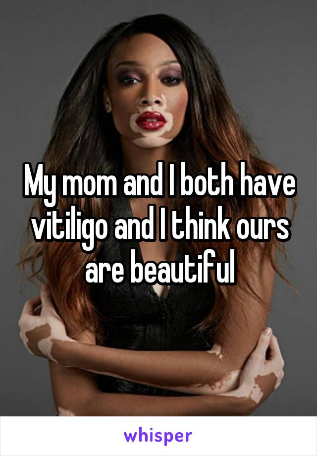 My mom and I both have vitiligo and I think ours are beautiful