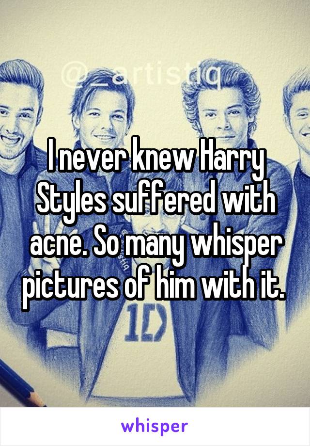 I never knew Harry Styles suffered with acne. So many whisper pictures of him with it. 