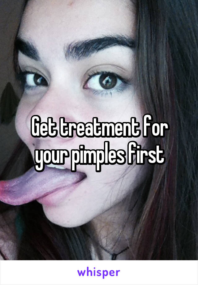 Get treatment for your pimples first