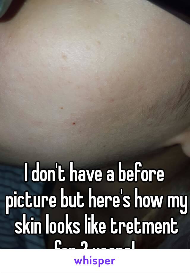 I don't have a before picture but here's how my skin looks like tretment for 2 years! 