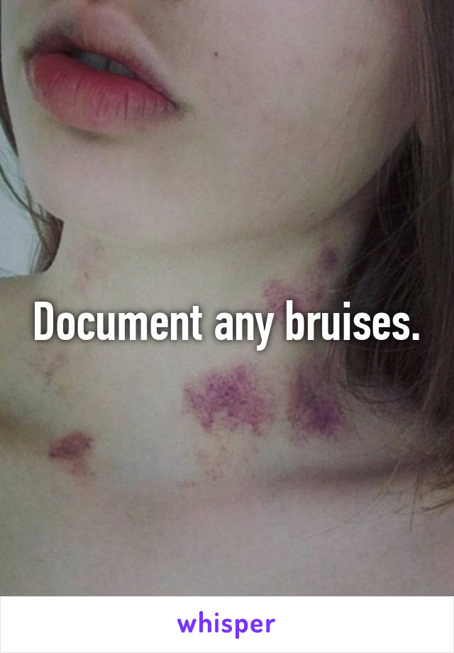 Document any bruises.