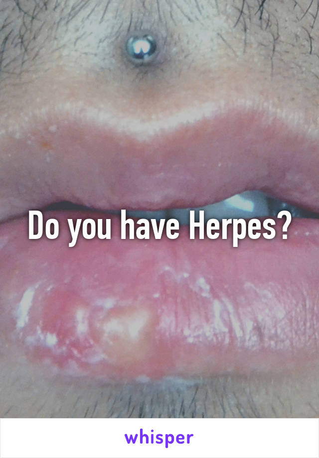 Do you have Herpes?