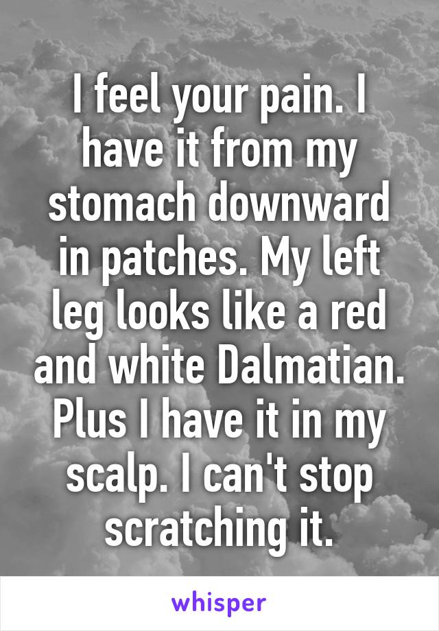 I feel your pain. I have it from my stomach downward in patches. My left leg looks like a red and white Dalmatian. Plus I have it in my scalp. I can't stop scratching it.