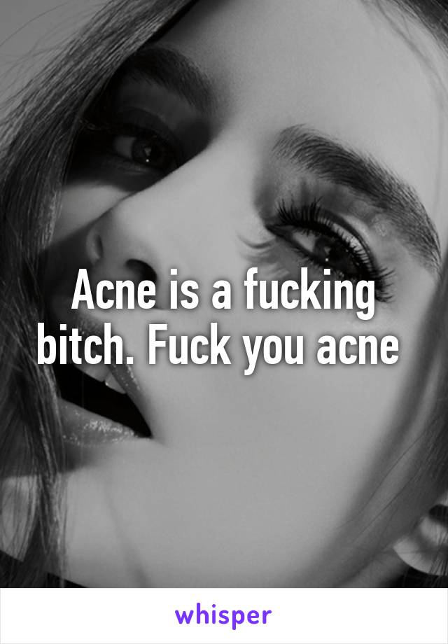 Acne is a fucking bitch. Fuck you acne 