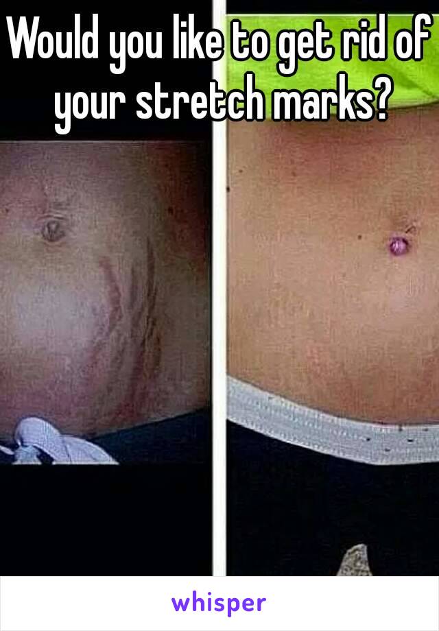 Would you like to get rid of your stretch marks?