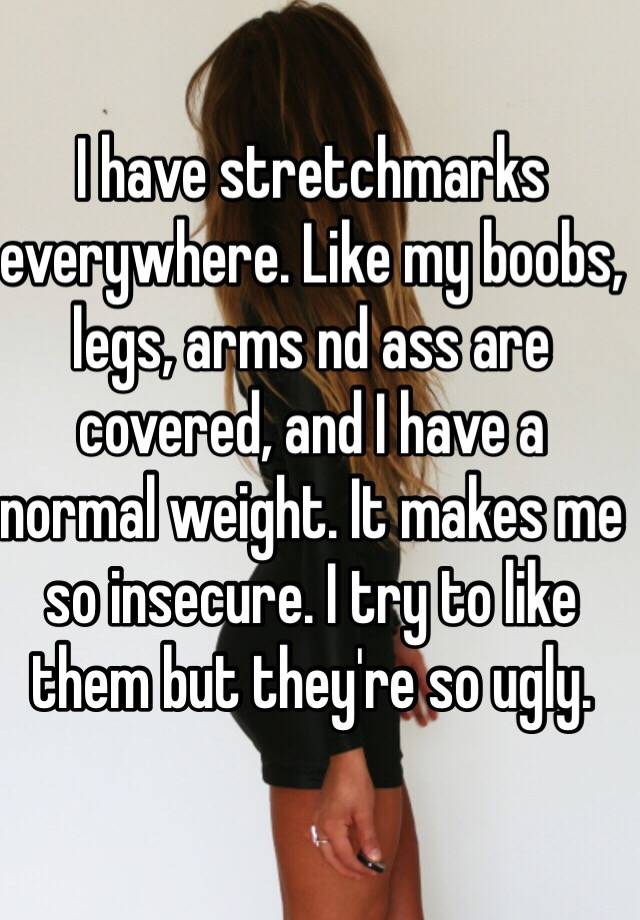 I have stretchmarks everywhere. Like my boobs, legs, arms nd ass are covered, and I have a normal weight. It makes me so insecure. I try to like them but they're so ugly. 