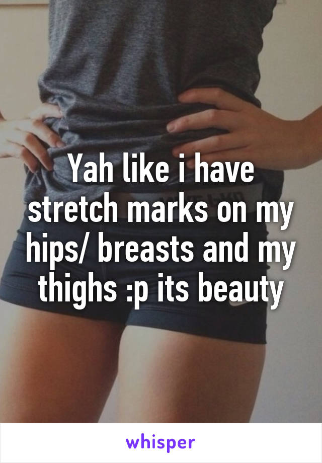 Yah like i have stretch marks on my hips/ breasts and my thighs :p its beauty