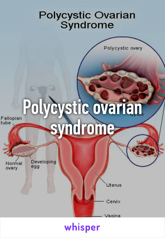 Polycystic ovarian syndrome