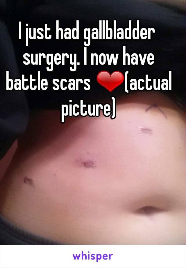 I just had gallbladder surgery. I now have battle scars ❤(actual picture)