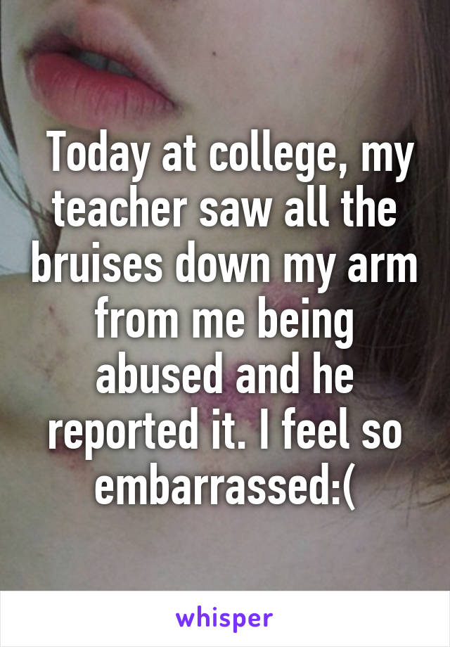  Today at college, my teacher saw all the bruises down my arm from me being abused and he reported it. I feel so embarrassed:(