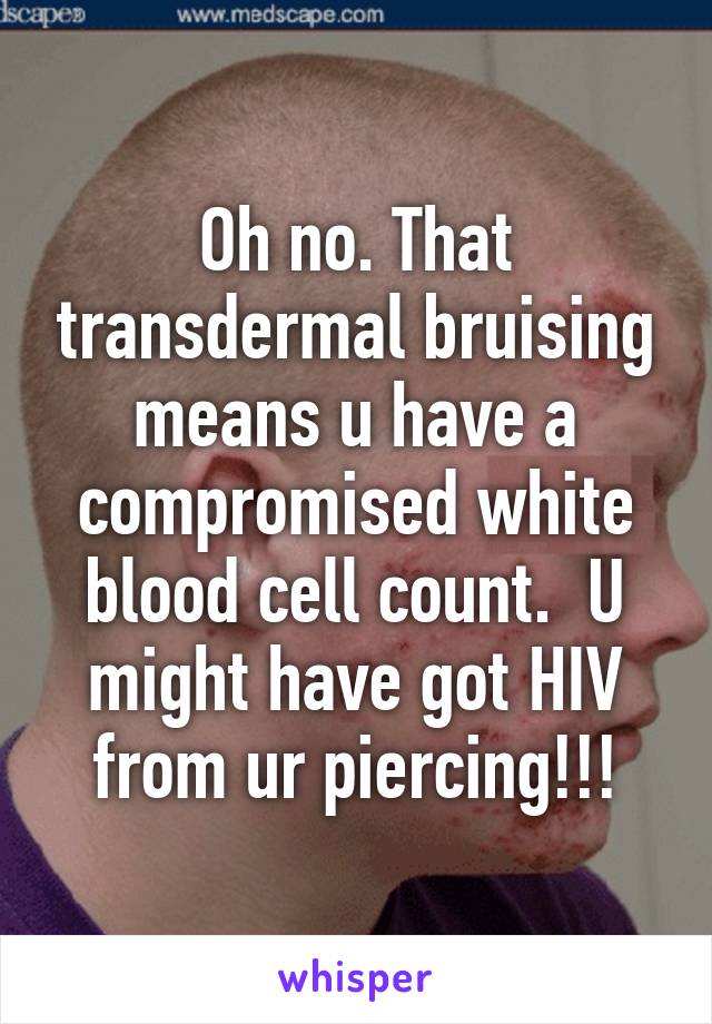 Oh no. That transdermal bruising means u have a compromised white blood cell count.  U might have got HIV from ur piercing!!!