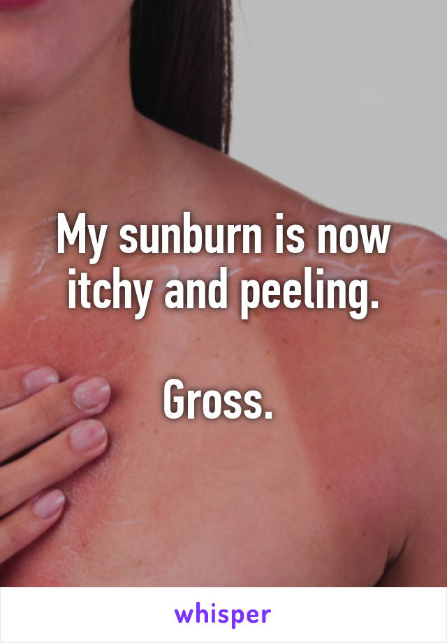My sunburn is now itchy and peeling.

Gross. 