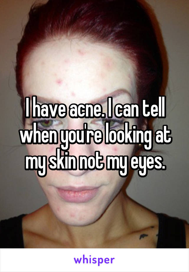 I have acne. I can tell when you're looking at my skin not my eyes.