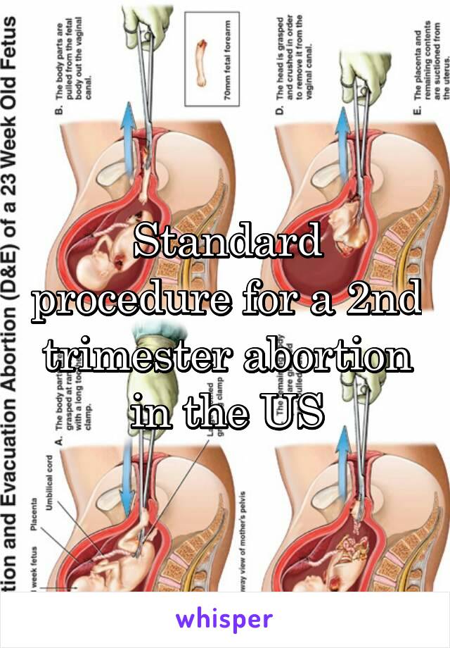 Standard procedure for a 2nd trimester abortion in the US