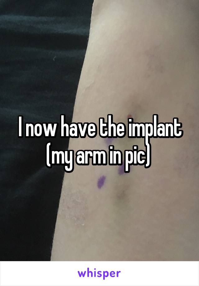 I now have the implant (my arm in pic) 