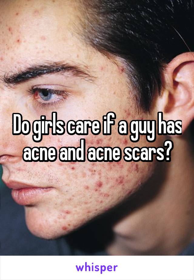 Do girls care if a guy has acne and acne scars?