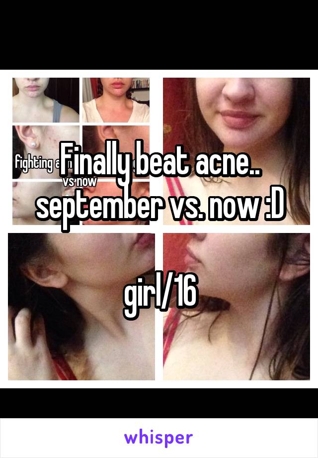 Finally beat acne..
september vs. now :D

girl/16