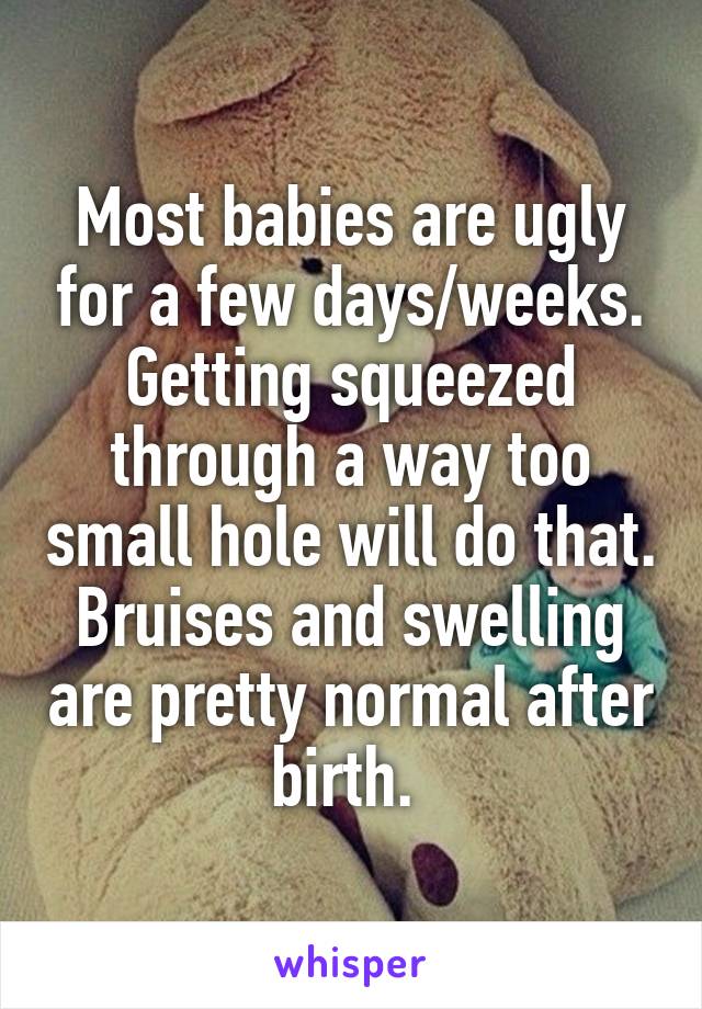 Most babies are ugly for a few days/weeks. Getting squeezed through a way too small hole will do that. Bruises and swelling are pretty normal after birth. 