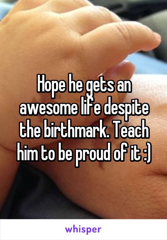 Hope he gets an awesome life despite the birthmark. Teach him to be proud of it :)