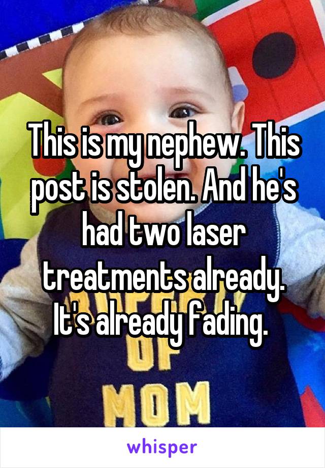 This is my nephew. This post is stolen. And he's had two laser treatments already. It's already fading. 