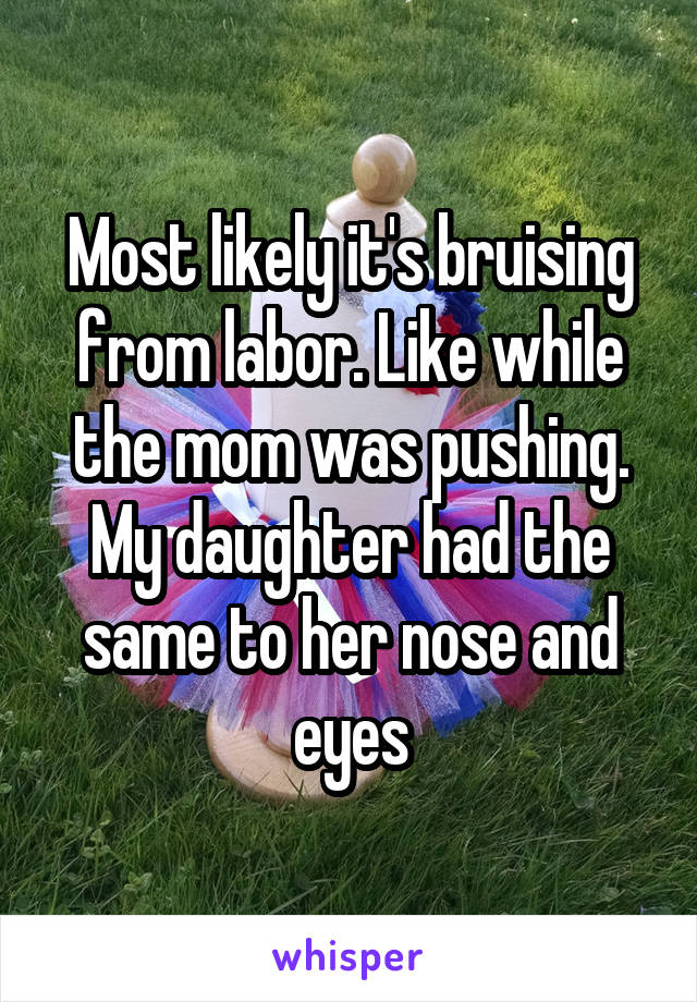 Most likely it's bruising from labor. Like while the mom was pushing. My daughter had the same to her nose and eyes