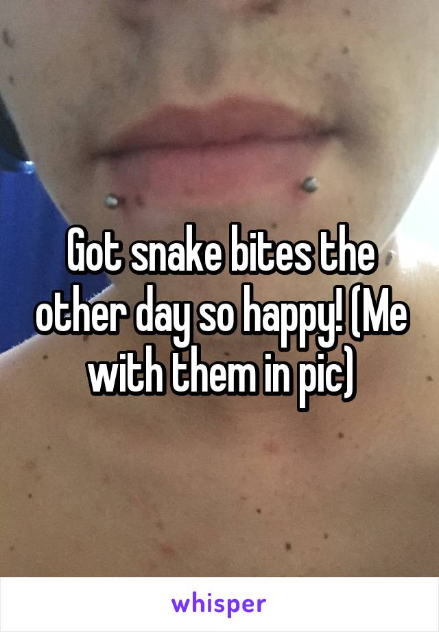 Got snake bites the other day so happy! (Me with them in pic)