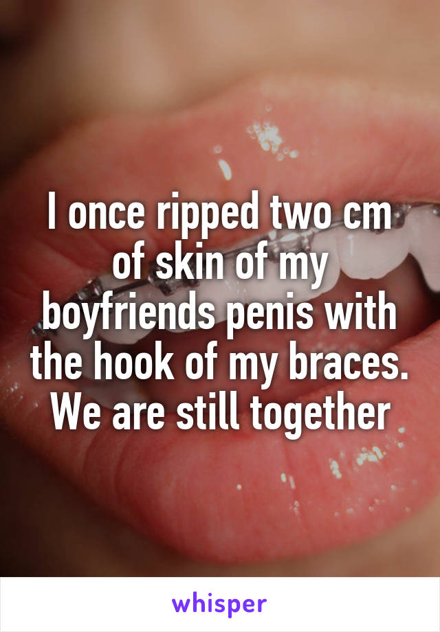 I once ripped two cm of skin of my boyfriends penis with the hook of my braces. We are still together
