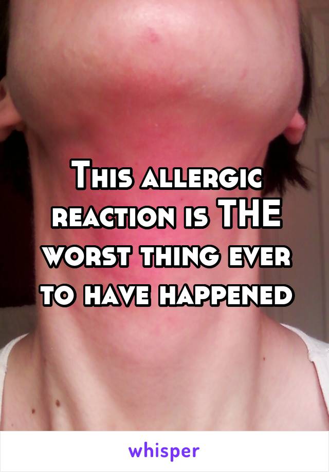 This allergic reaction is THE worst thing ever to have happened