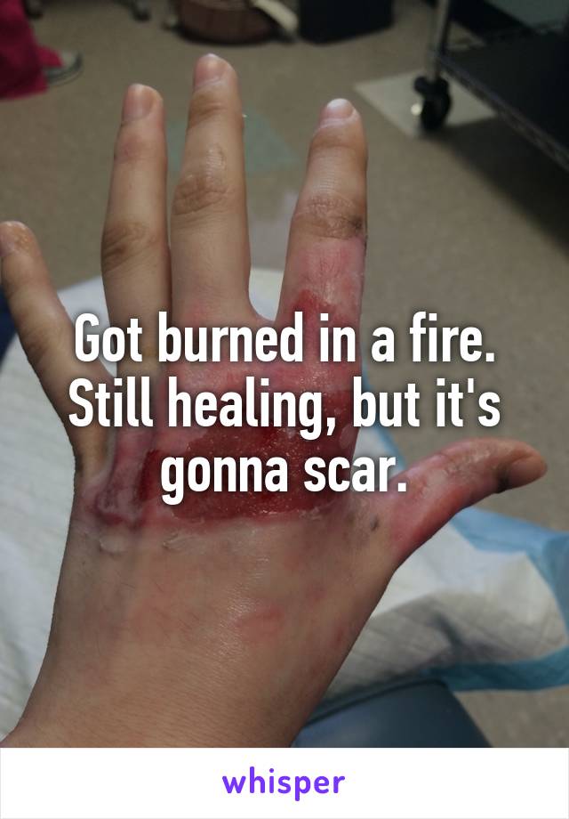 Got burned in a fire. Still healing, but it's gonna scar.